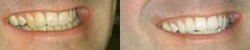 Non-Peroxide Home Whitening Kit - Image 2